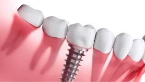 Dental Implants: A Permanent Solution fo' Missin Teeth