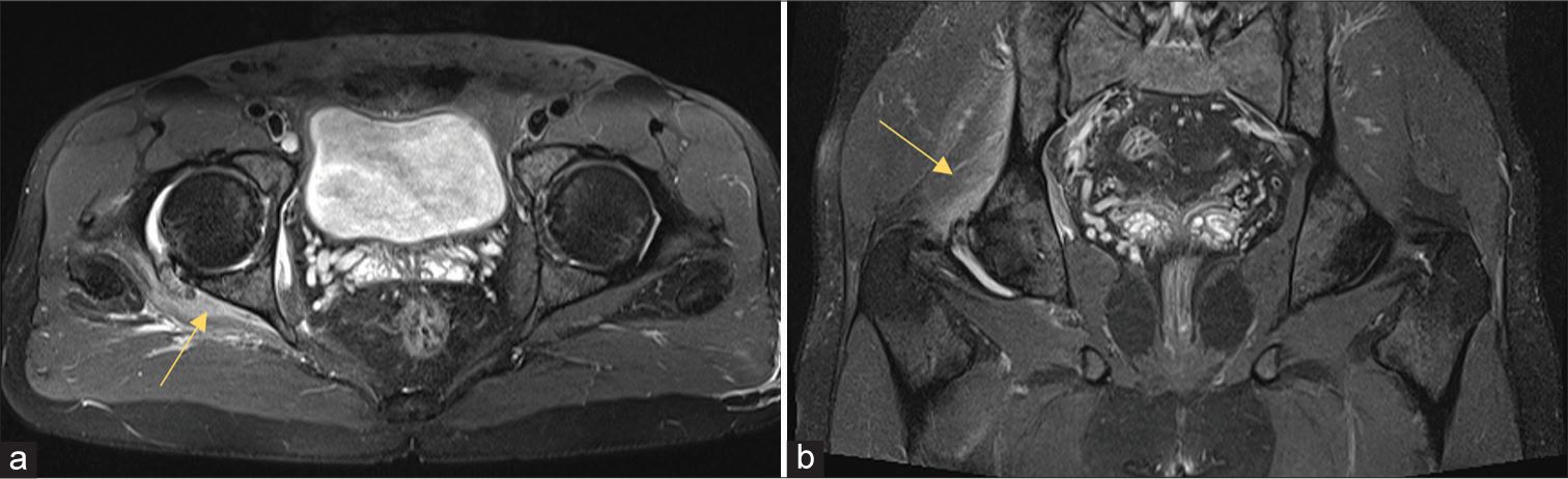 Hydroxyapatite Deposition Disease and Erosion Deposition Guide